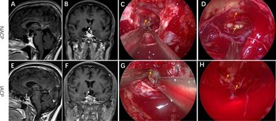 Correlations between the expression of molecules in the TGF-β signaling pathway and clinical factors in adamantinomatous craniopharyngiomas